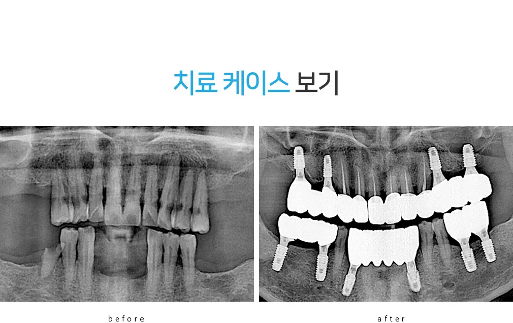 치료 전후를 비교한 파노라마 엑스레이, 상실된 치열과 보철이 올라간 상태