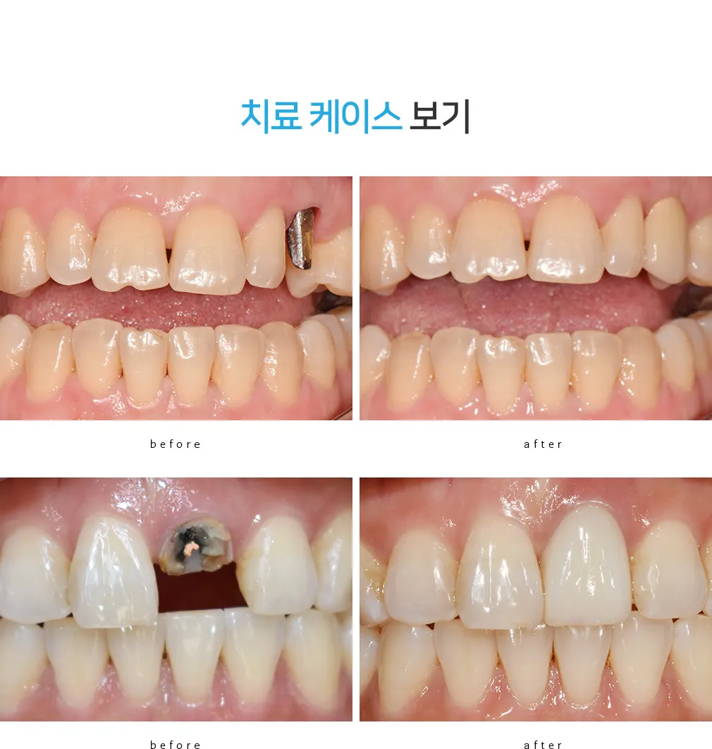 치료 전후를 비교한 구강 사진 두 쌍. 아래쪽이 앞니 보철이다