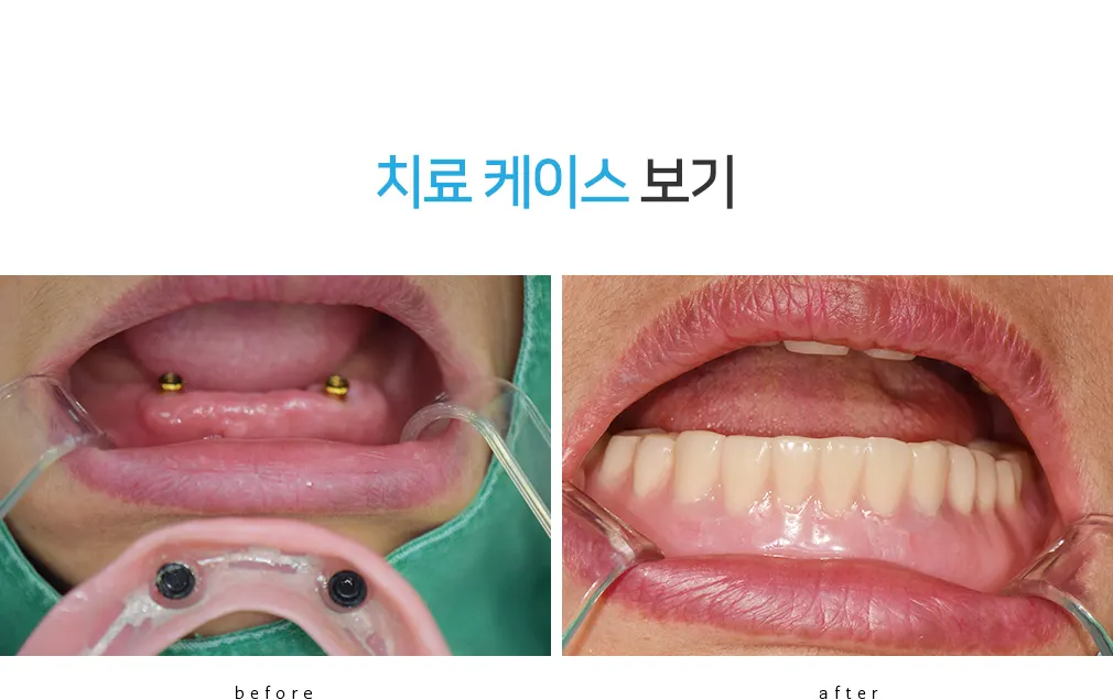 06 denture4 — 일등플란트치과의원